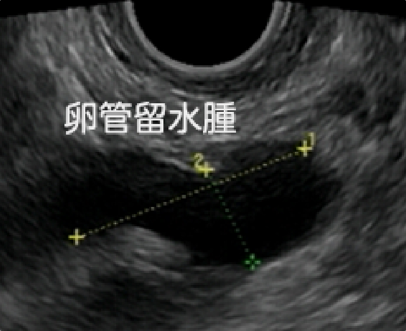 卵管留水腫の症状