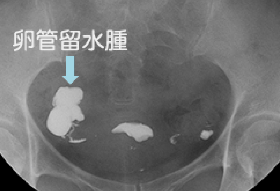 子宮卵管造影検査